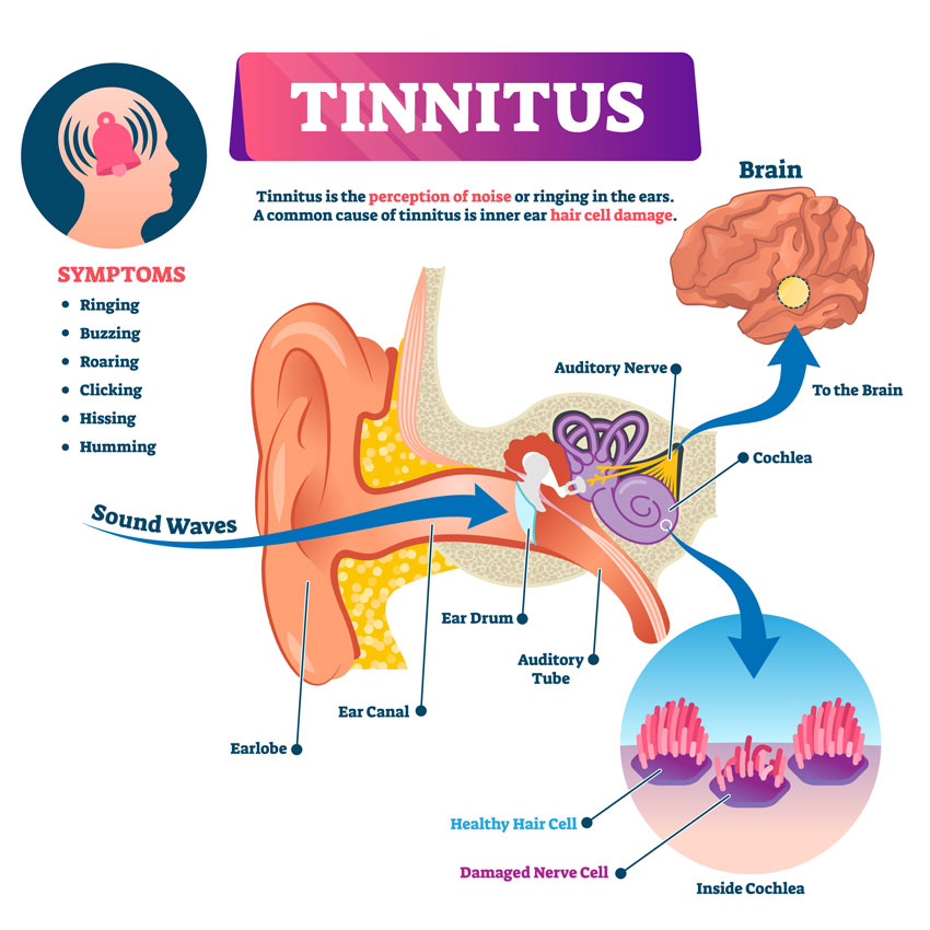tinnitus symptoms and anatomy